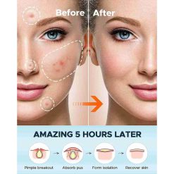 pimple acne skin recover patches for females